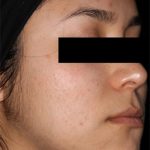 AviClear Before & After Patient #1670